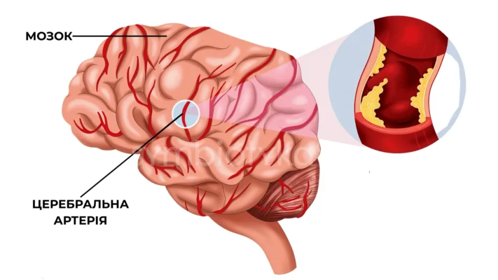 Поширені хвороби мозку: симптоми, діагностика та лікування