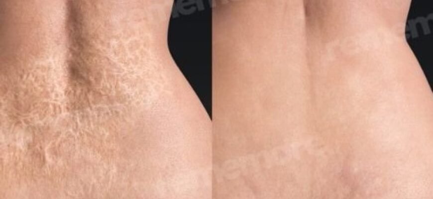 Пересадка шкіри при опіках: сучасні методи та технології лікування