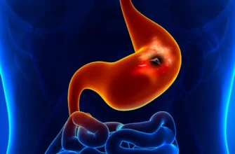 Виразкова хвороба 12 палої кишки: код МКХ 10 та лікування