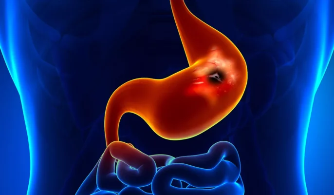 Виразкова хвороба 12 палої кишки: код МКХ 10 та лікування