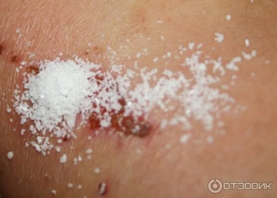 Чи можна засипати рану стрептоцидом: безпечність та ефективність