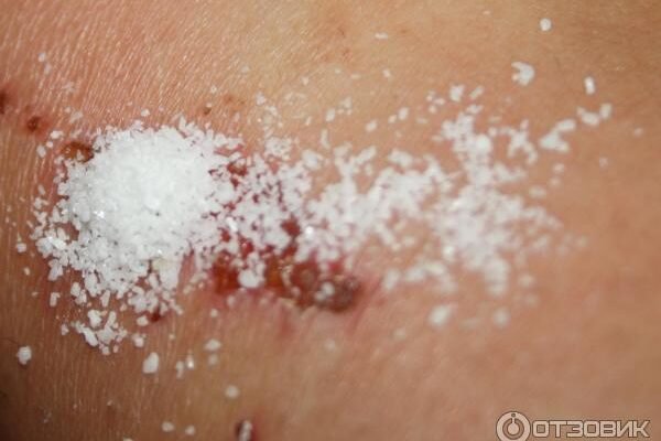 Чи можна засипати рану стрептоцидом: безпечність та ефективність