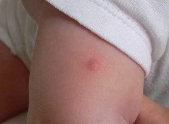 Укус комара у дитини: як захистити малюка і зменшити свербіж