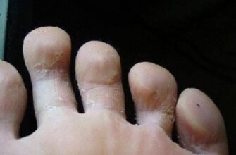 Облазить шкіра на пальцях у дитини: причини та рішення проблеми