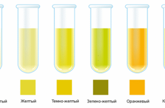 Колір сечі при пієлонефриті: що важливо знати для здоров’я?