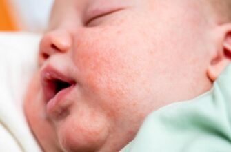 Причини та лікування: висип на обличчі у дитини – що робити?