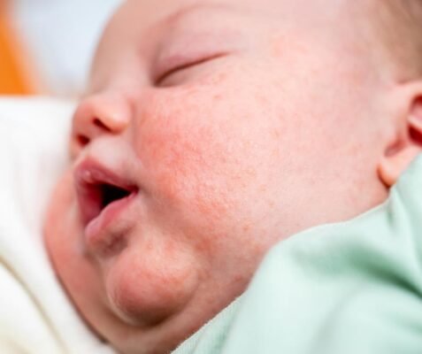Причини та лікування: висип на обличчі у дитини – що робити?
