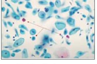 Тип 2 реактивні зміни клітин плоского епітелію: що варто знати