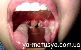 Як швидко вилікувати ангіну у дитини: ефективні методи та поради