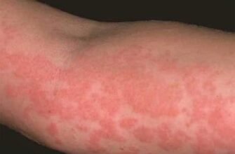 Дерматит: як лікувати шершаві плями на шкірі у дитини ефективно?