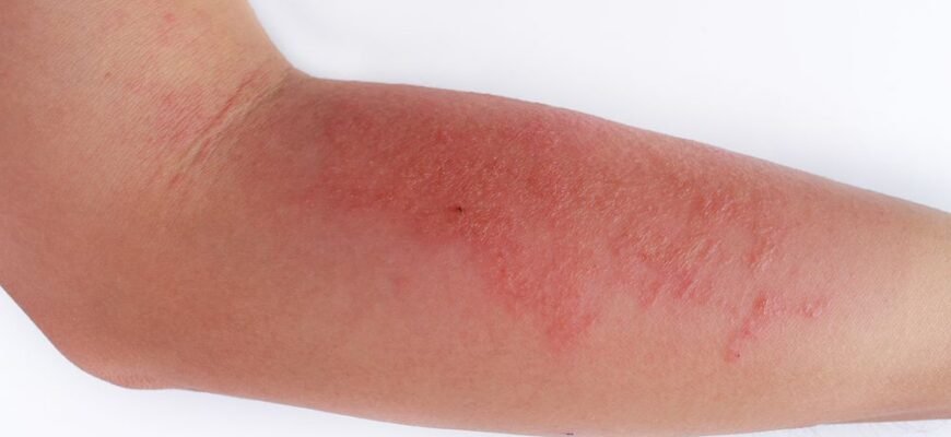 Атопічний дерматит у дитини: симптоми, лікування та поради лікарів