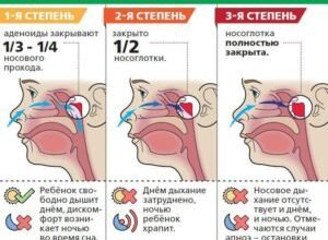 Кашель при аденоїдах у дитини: причини, симптоми, лікування