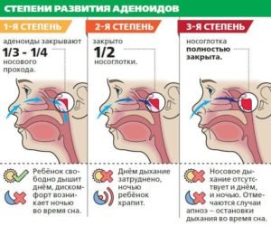 Кашель при аденоїдах у дитини: причини, симптоми, лікування