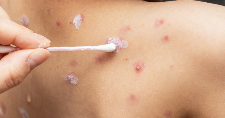 Герпетичні інфекції у дітей: симптоми, діагностика, лікування Герпетичні інфекції у дітей: симптоми, діагностика, лікування