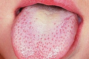 Причини та лікування біло жовтого нальоту на язику у дитини