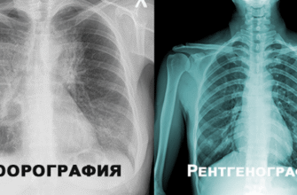 Рентген і флюорографія: у чому різниця між цими методами діагностики?