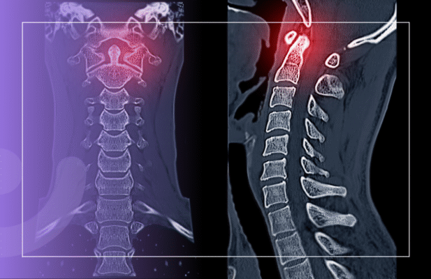 Хвороба Бехтерєва мобілізація: Як впливає мобілізація на стан хворих