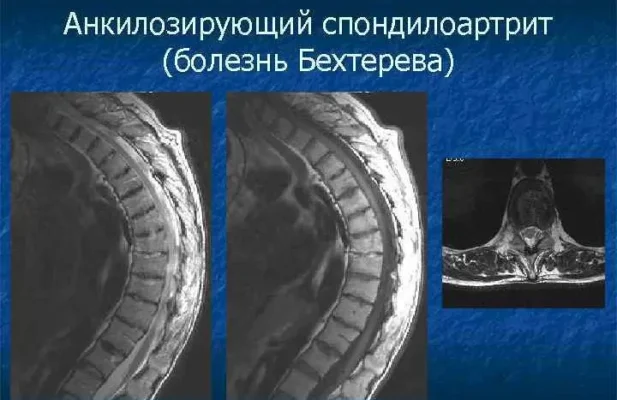 Хвороба Дегтярьова: симптоми, діагностика та методи лікування