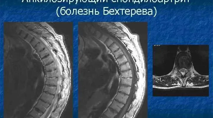 Хвороба Дегтярьова: симптоми, діагностика та методи лікування