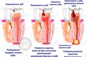 Чому болить зуб при натисканні: головні причини і поради лікаря