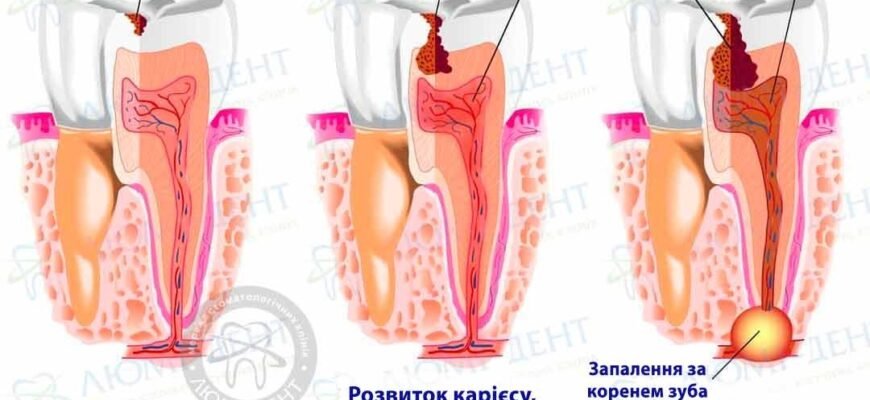 Чому болить зуб при натисканні: головні причини і поради лікаря
