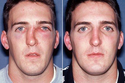 Як відрізнити перелом носа від забою у дитини: поради батькам