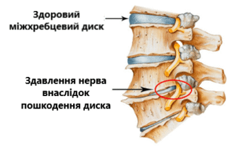 Компресія нервових корінців: ураження міжхребцевого диска