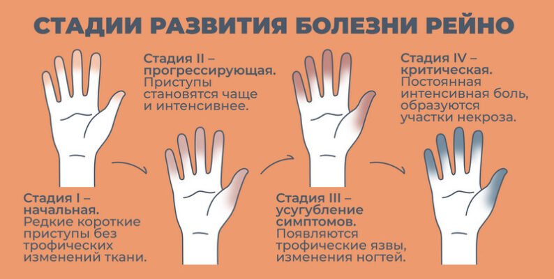 Раціон харчування при синдромі Рейно: продукти та поради лікарів