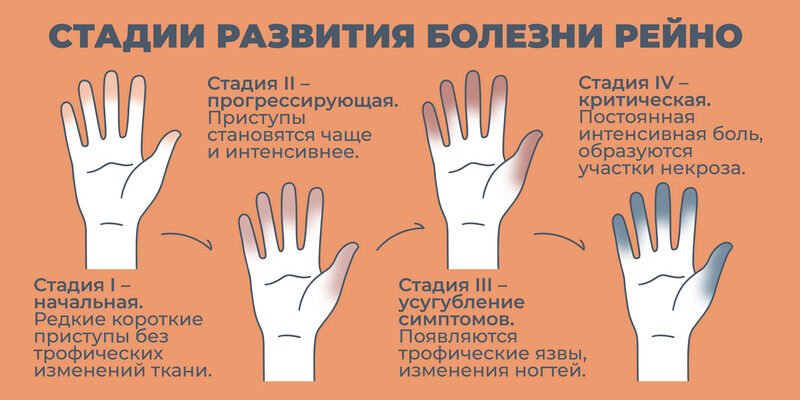 Раціон харчування при синдромі Рейно: продукти та поради лікарів