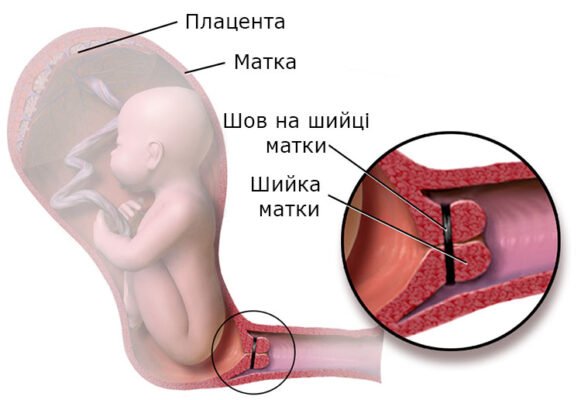 Шийка матки при вагітності: особливості змін і важливість моніторингу