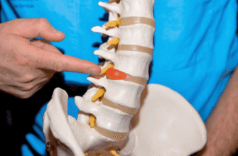 Що не можна робити при грижі шийного відділу хребта: поради лікарів