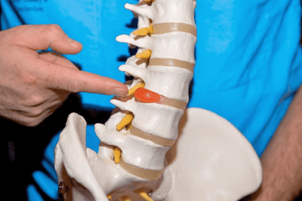 Що не можна робити при грижі шийного відділу хребта: поради лікарів