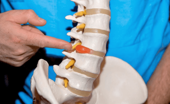 Що не можна робити при грижі шийного відділу хребта: поради лікарів