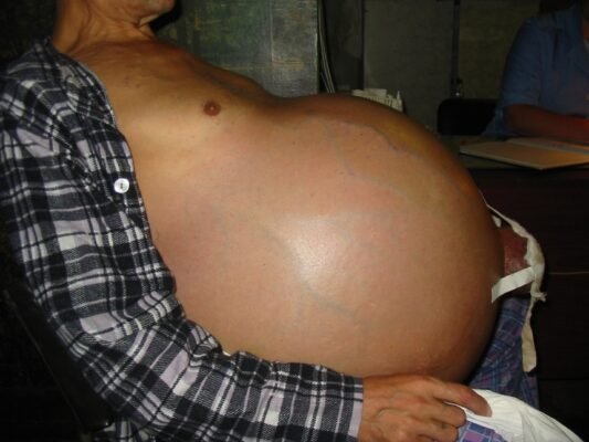 Живот при циррозе печени: фото змін і симптоми патології