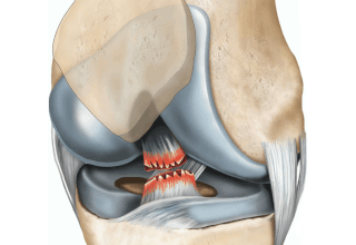 Дегенеративні зміни передньої хрестоподібної зв’язки: симптоми та лікування