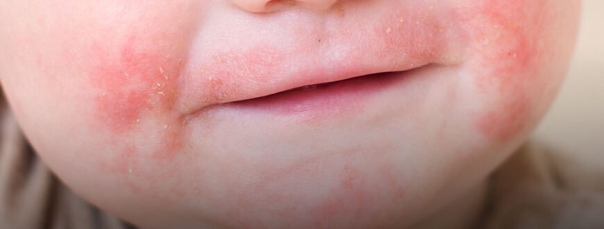 Дерматит: Шершаві Плями на Шкірі у Дитини – Фото та Роз’яснення Дерматит: Шершаві Плями на Шкірі у Дитини – Фото та Роз’яснення