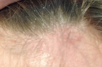 Лусочки на голові у дитини 6 років: причини та способи боротьби