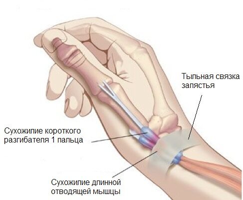 Хвороба де Кервена: причини, симптоми та методи лікування