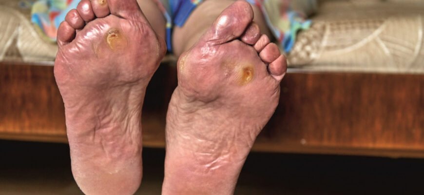 Плями на ногах при цукровому діабеті: причини та лікування