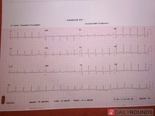 Дистрофічні зміни міокарда: причини, симптоми та лікування