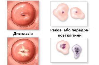 Реактивні зміни епітелію тип 2: причини, діагностика та лікування