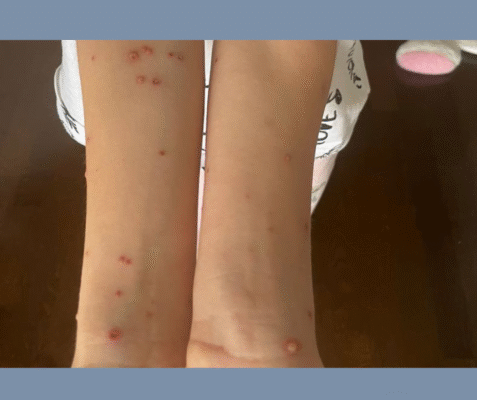 Вітрянка у дитини: симптоми, лікування та профілактика захворювання