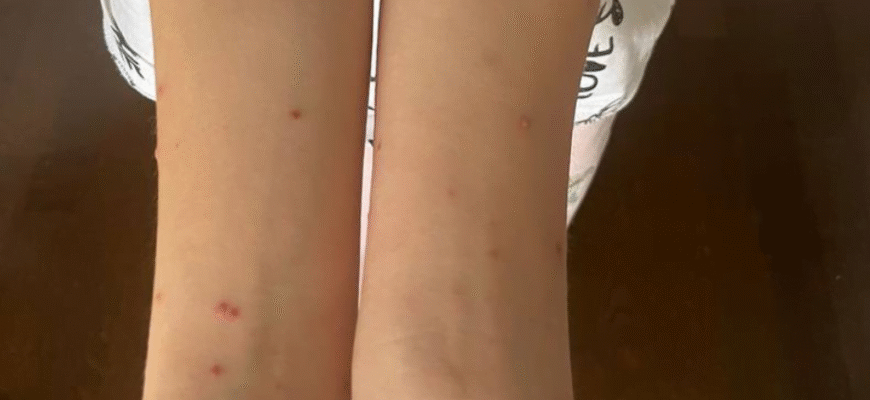 Вітрянка у дитини: симптоми, лікування та профілактика захворювання