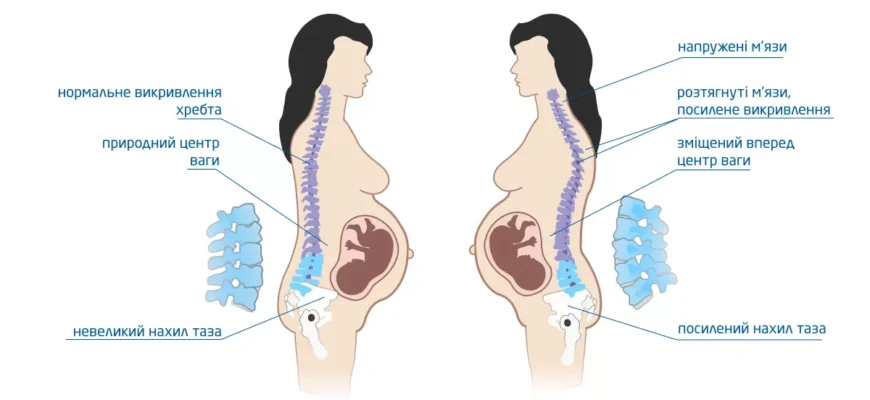 Болить поперек при вагітності: причини та поради для полегшення болю