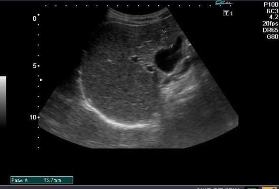 Дифузні зміни печінки: причини, симптоми та лікування Дифузні зміни печінки: причини, симптоми та лікування