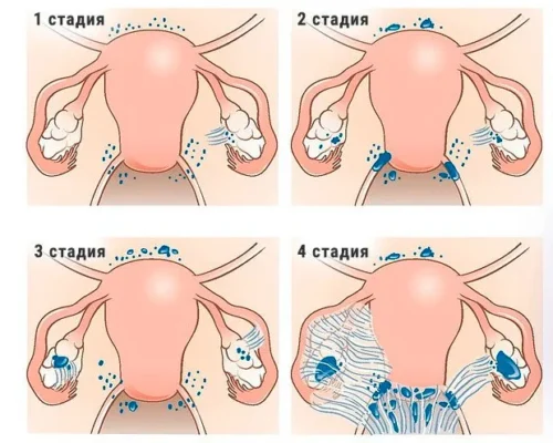 Як протікає вагітність при ендометріозі: ключові аспекти Як протікає вагітність при ендометріозі: ключові аспекти