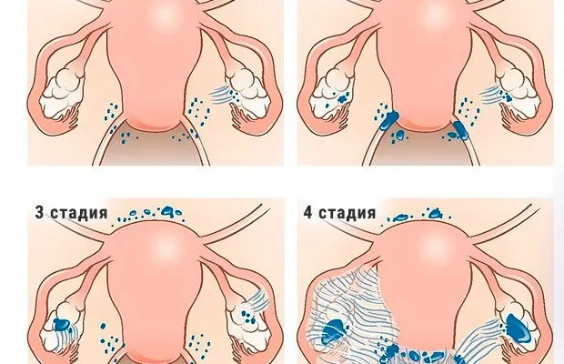 Як протікає вагітність при ендометріозі: ключові аспекти