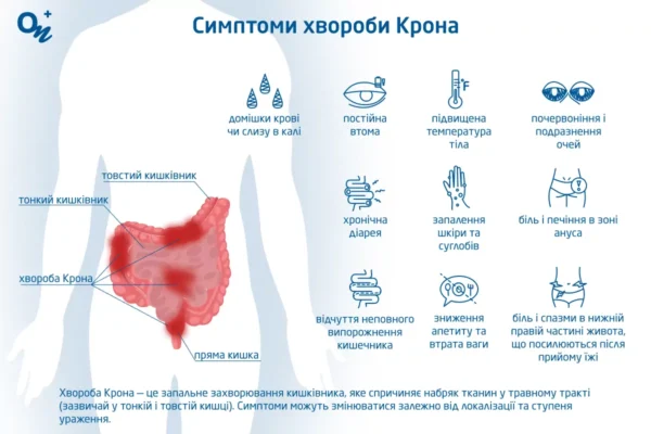 Хвороба Крона: як лікувати та покращити якість життя?