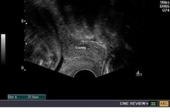 Цервікометрія при вагітності: норма, визначення та важливість діагностики