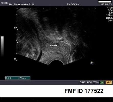 Цервікометрія при вагітності: норма, визначення та важливість діагностики